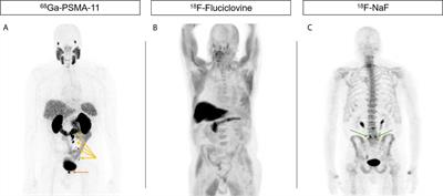 Incorporating PSMA-Targeting Theranostics Into Personalized Prostate Cancer Treatment: a Multidisciplinary Perspective